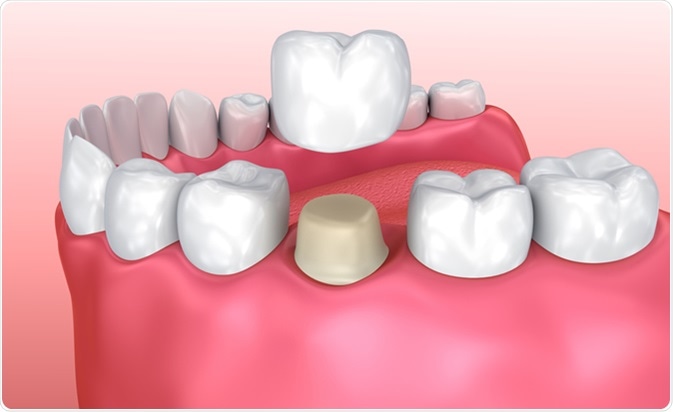 Dental crown or tooth cap