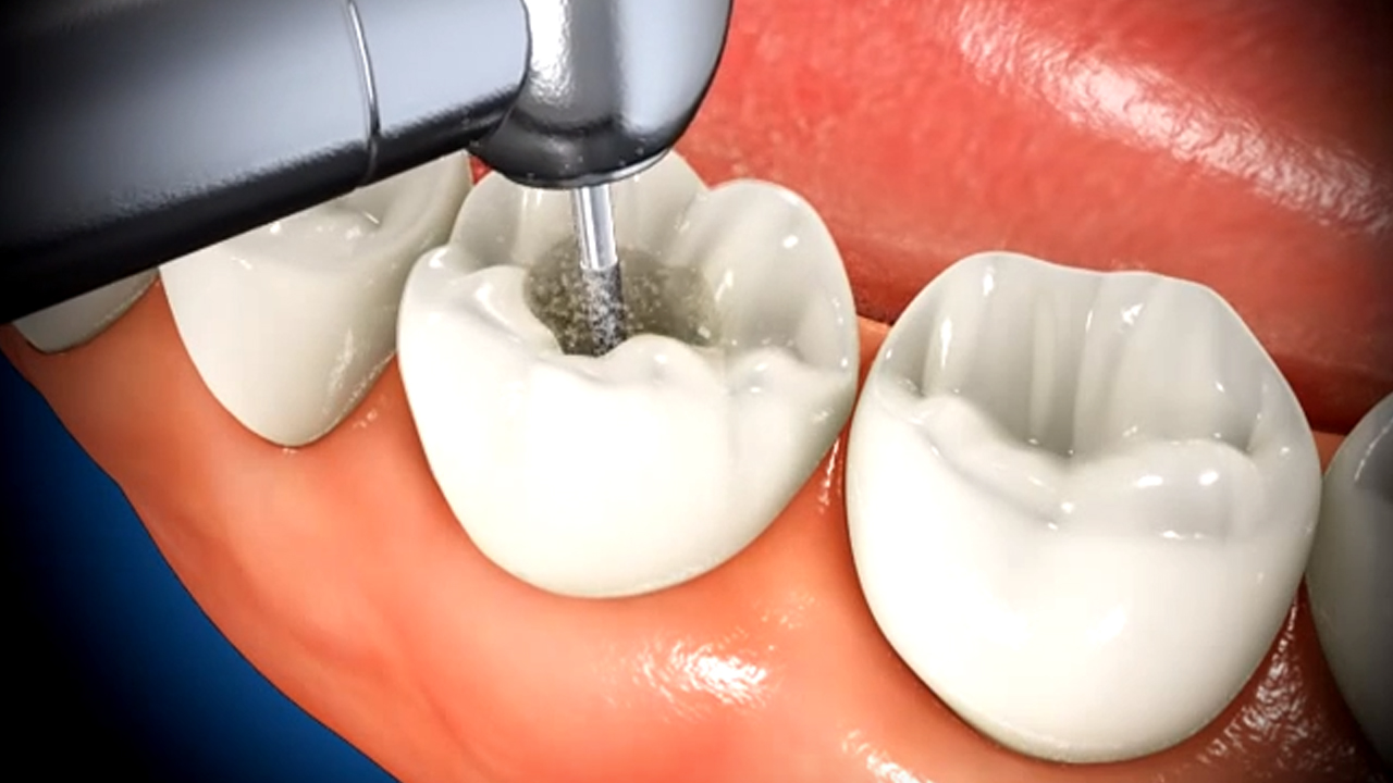 What Is A Root Canal? And Do I Need One?